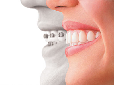 Bright Smile Dental Care, LTD | Root Canals, Sleep Apnea and Night Guards