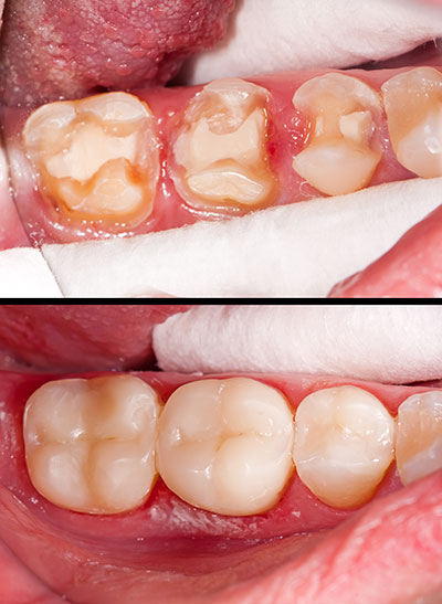 Bright Smile Dental Care, LTD | Oral Exams, Ceramic Crowns and Veneers