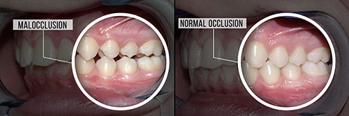 Bright Smile Dental Care, LTD | Snoring Appliances, Teeth Whitening and Dental Fillings
