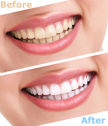 Bright Smile Dental Care, LTD | Inlays  amp  Onlays, ClearCorrect reg  and Sleep Apnea
