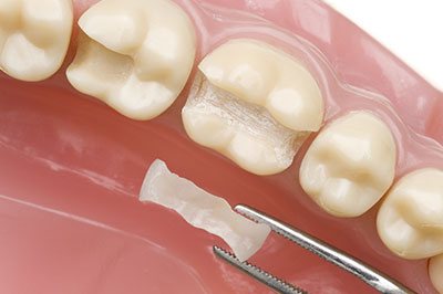 Bright Smile Dental Care, LTD | Preventative Program, Ceramic Crowns and Dental Bridges