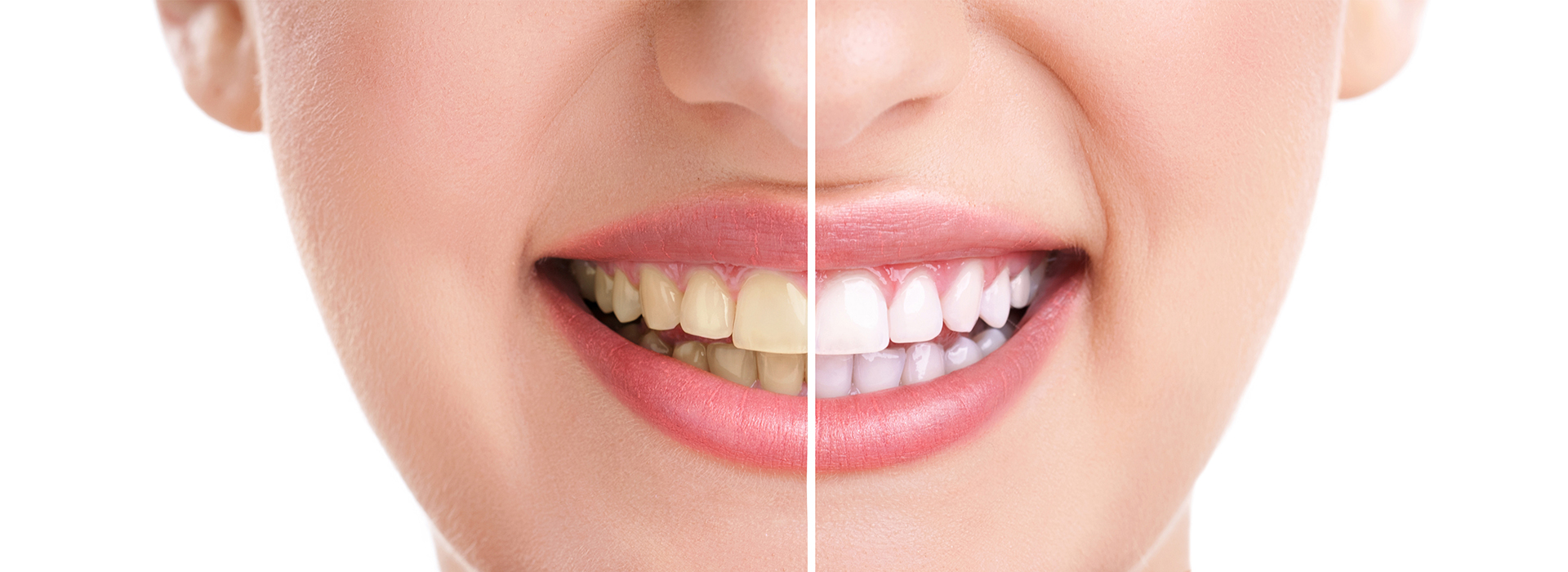 Bright Smile Dental Care, LTD | Juvederm reg , ClearCorrect reg  and Sedation Dentistry